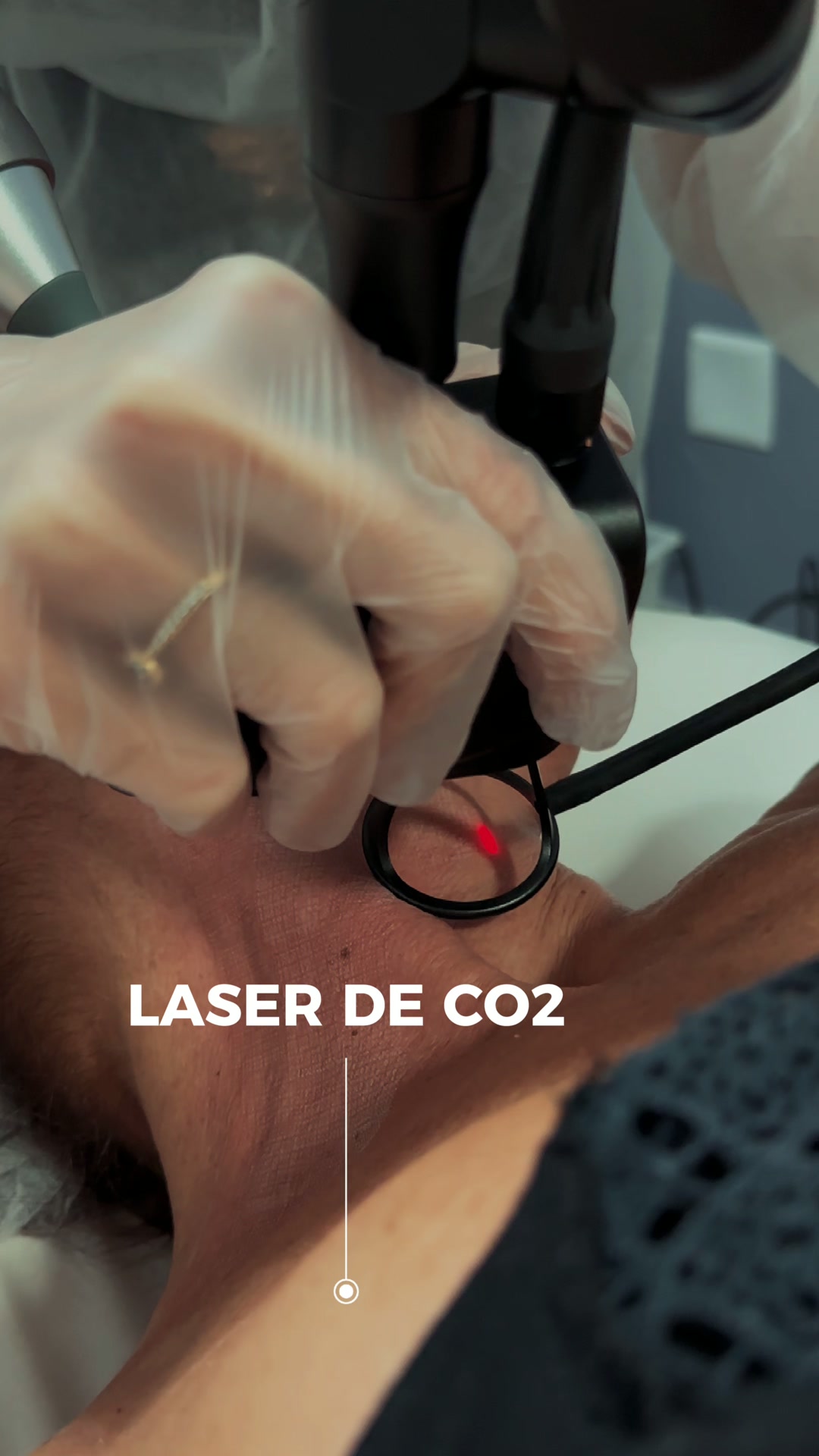 Laser de CO₂ na prática: aplicação com parâmetros ajustados